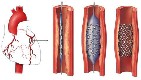 Heart Stent Procedure: A Step.